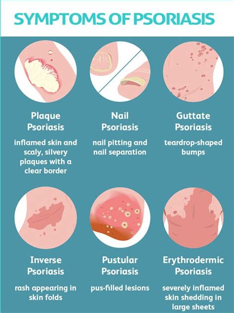 Psoriasis Diagnosis and Treatment in Thailand - Almurshidi Medical ...