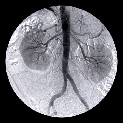 What are the Complications of Endovascular Aneurysm Repair?