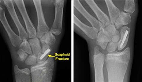 Scaphoid Fracture of the Wrist - OrthoInfo - AAOS