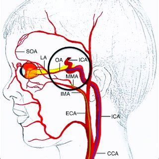 (PDF) Intra-arterial chemotherapy in retinoblastoma – A paradigm change