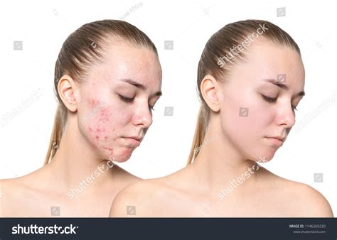 Young Woman Before After Acne Treatment Stock Photo 1146369230 ...