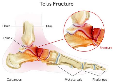 Talus fracture causes, types, symptoms, complications, diagnosis ...