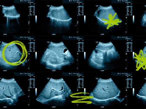 Normal Vs Fatty Liver Ultrasound