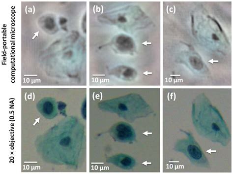 Lensfree computational images of abnormal cells in a Pap smear sample ...