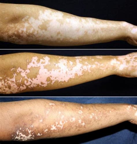 Afamelanotide tested as a new treatment for vitiligo – Vitiligo Clinic