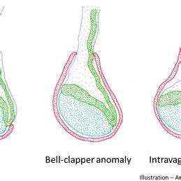 Globular testicular enlargement and heterogeneous echotexture. a ...