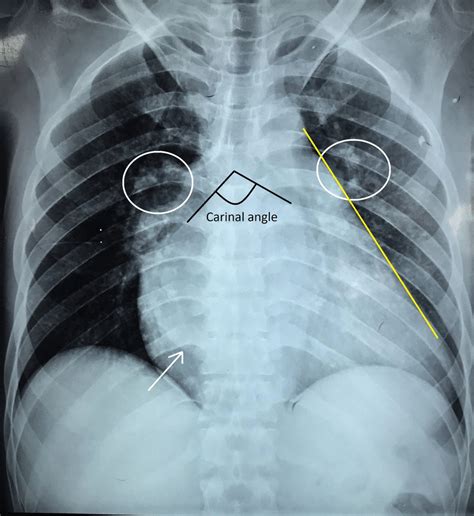 Chest X Ray Posteroanterior View Of Patient Depicting Cardiomegaly ...