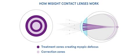 MiSight Daily Myopia Control Contact Lenses — Eye Academy