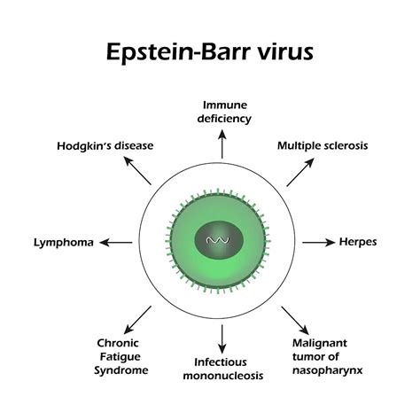 Epstein Barr Virus: Types, Symptoms, Treatment, Home Remedies | STD.GOV ...