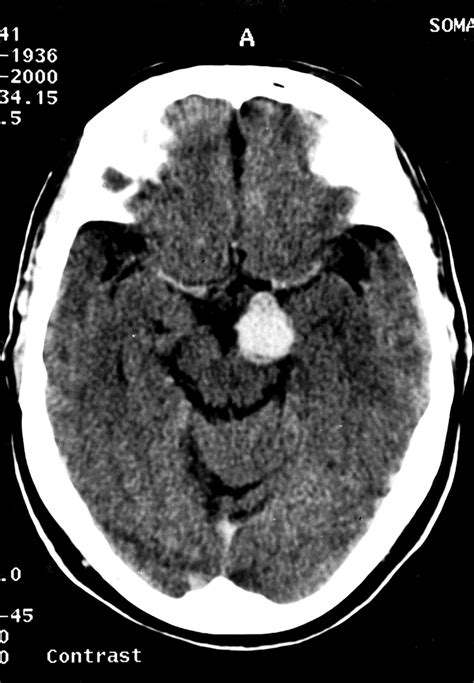 Brain Aneurysm Ct Scan - Diagnosis of a brain aneurysm may require ct ...