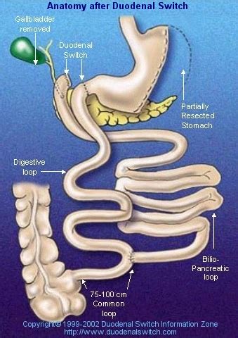 Duodenal Switch