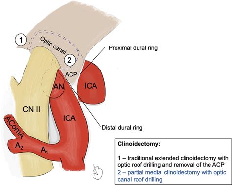 Comparison between the extents of clinoidectomy for the clipping of OA ...