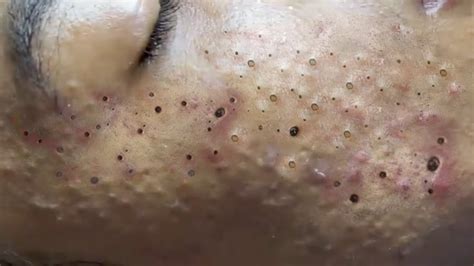 New Blackhead Removal Oct 28 2025 - Devan Fenelia