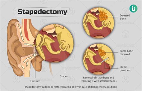 Stapedectomy: Procedure, Purpose, Results, Cost, Price