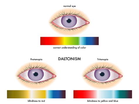 Colour Blindness Symptoms, Causes and Treatments