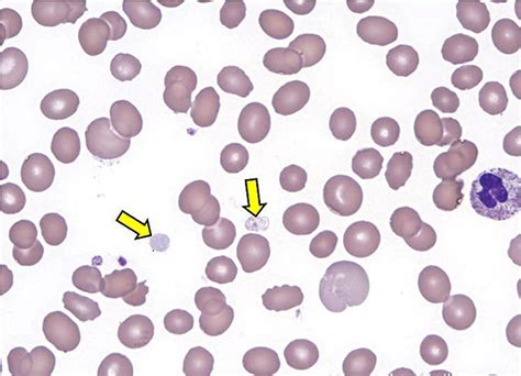 Platelet Count - High & Low Platelet Count, Causes & Treatment