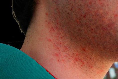 Natural Remedies Helps You to Get Rid of Eczema Scars - The Lahore Times