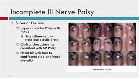 3Rd Cranial Nerve Palsy : Aberrent Regeneration, 3rd Nerve Palsy / It ...