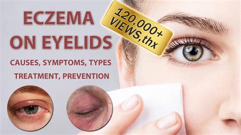 Eczema Eyelids