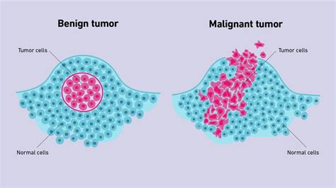 Benign vs Malignant Tumors | Technology Networks