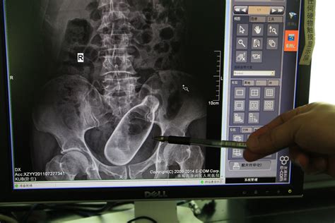 X-ray shows bottle stuck inside constipated Chinese hospital patient ...