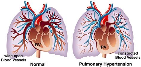 Pulmonary hypertension & pulmonary arterial hypertension causes ...