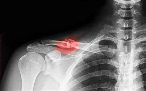 Broken collarbone or clavicle fracture signs, symptoms and treatment