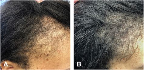 Minoxidil Before And After: Photos & Results | Wimpole Clinic