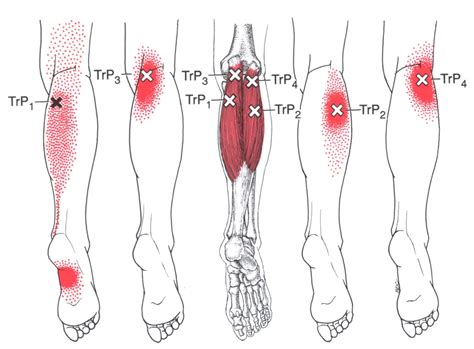 Gastrocnemius | The Trigger Point & Referred Pain Guide