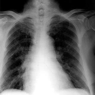 Purpuric and petechial rash involving the periumbilical area, abdomen ...