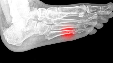 5th Metatarsal Fracture Exercises: Physical Therapy Protocol