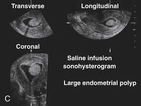 Hysterosalpingography and Sonohysterography | Basicmedical Key