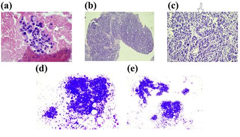 -(A, B, C) Histopathology images of the pleural biopsy specimen showing ...