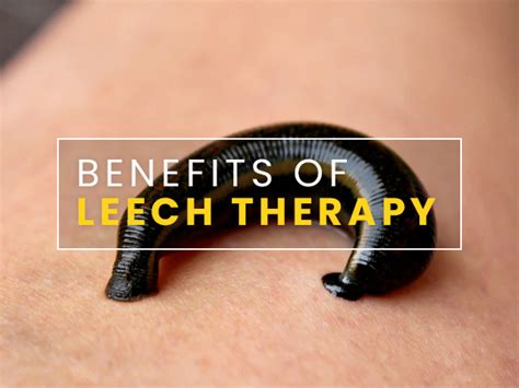 What Is Leech Therapy? Proven Health Benefits And Side Effects ...