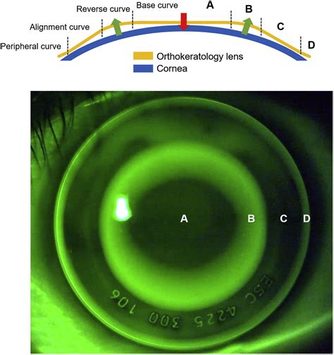 BCLA CLEAR - Orthokeratology - Contact Lens and Anterior Eye