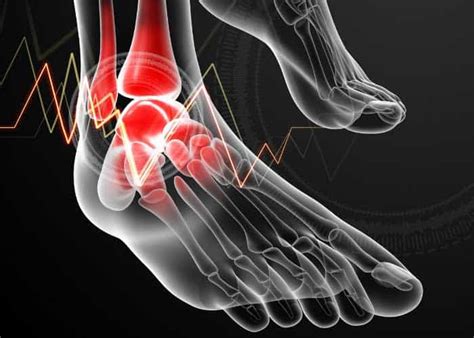 Osteochondral Ankle Injury | Osteochondritis Dissecans (OCD) Bone ...