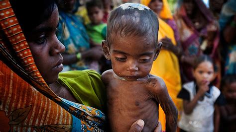 India's Malnutrition Challenge