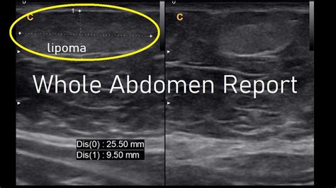 Small lipoma epigastric region | Ultrasound | Report | Amader hospital ...