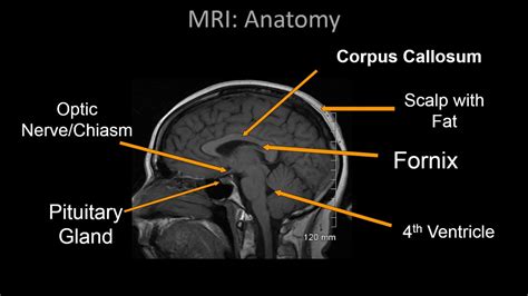 MRI Protocols: OPTIC CHIASM in lateral BRAIN MRI