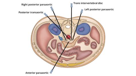 Celiac Plexus Block - OpenAnesthesia