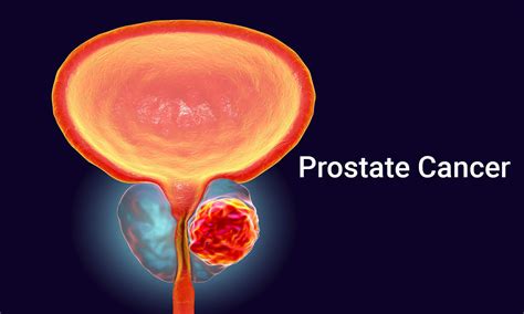 FDA Approves first Oral Hormone Therapy for Treating Advanced Prostate ...