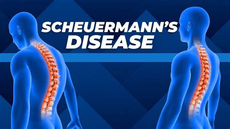 Top Three Exercises for Scheuermann's Disease - YouTube