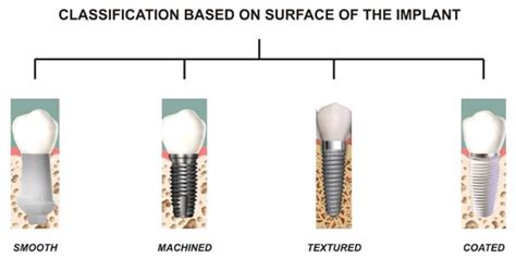 Types of Dental Implants by Sizes, Procedures and Materials