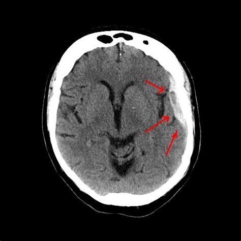 Subdural Hematoma | Symptoms, treatment & recovery | SportsMD