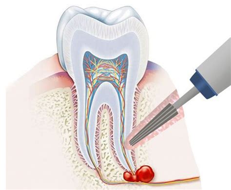 Methods of dental cyst treatment. Surgery, laser, total tooth removal.