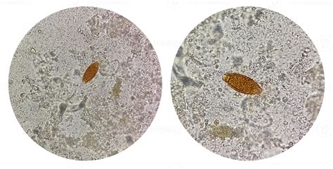 Photo collage of Trichuris trichiura ova whipworm in stool, analyze by ...