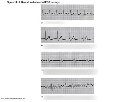 Normal Vs Abnormal Ecg