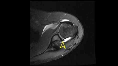 Shoulder MRI: Bankart Lesion - YouTube