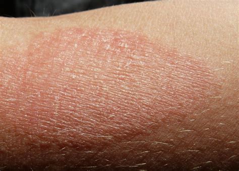 Eczema: Symptoms, treatment, and causes