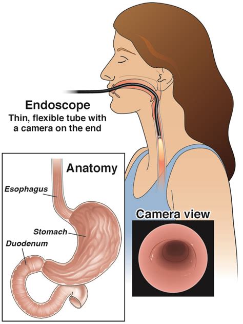 Endoscopy (upper GI) - AGA GI Patient Center